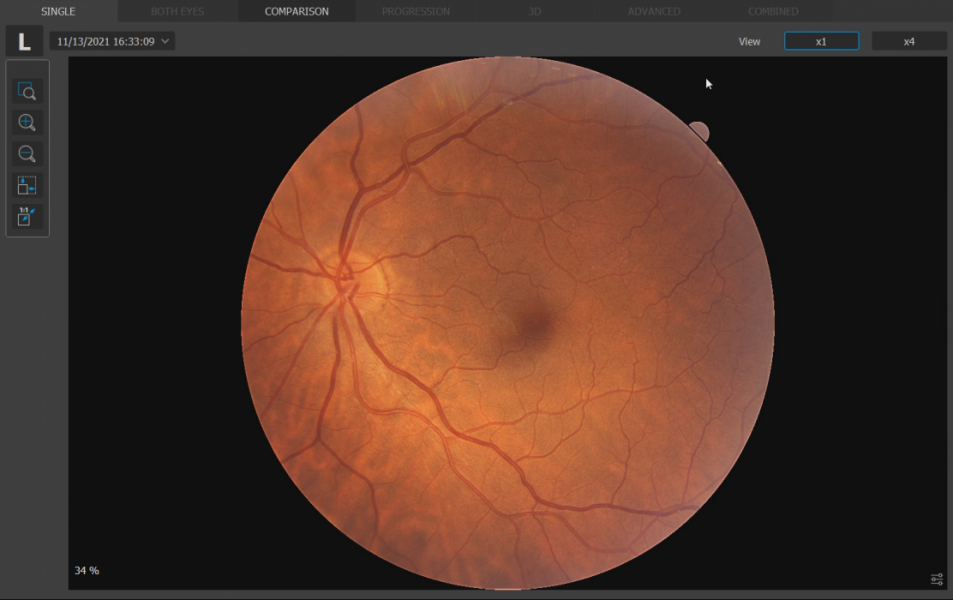 Non-Mydriatic Color Fundus Photography