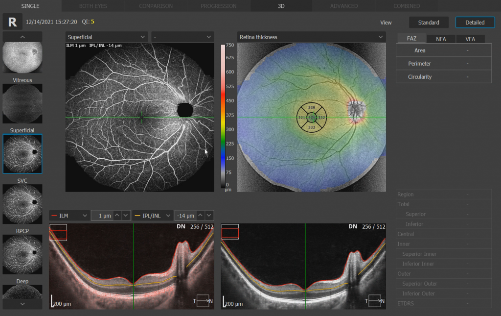 Anterior Segment OCT Webinar - OPTOPOL Technology | Ophthalmic ...